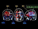 Lack of empathy following traumatic brain injury associated with reduced responsiveness to anger | Empathy Movement Magazine | Scoop.it