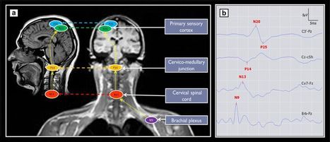 Nouvel outil de pronostic précoce des personnes sous fortes doses de sédatifs | Life Sciences Université Paris-Saclay | Scoop.it