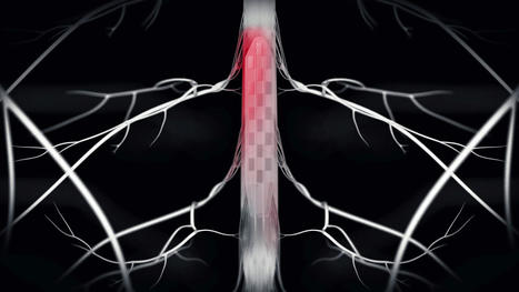 Percée majeure dans le traitement de la maladie de Parkinson : une neuroprothèse permet de restaurer une marche fluide | RééDOC  - IRR Nancy : Actualités en Médecine Physique et de Réadaptation (MPR) - UGECAM Nord-Est | Scoop.it