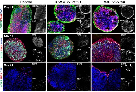 Modeling Rett Syndrome With Human Patient-Specific Forebrain Organoids | iBB | Scoop.it