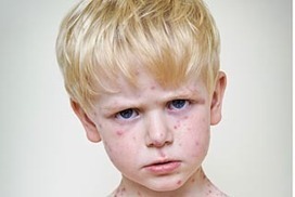 A pox on both your parents | Virology News | Scoop.it